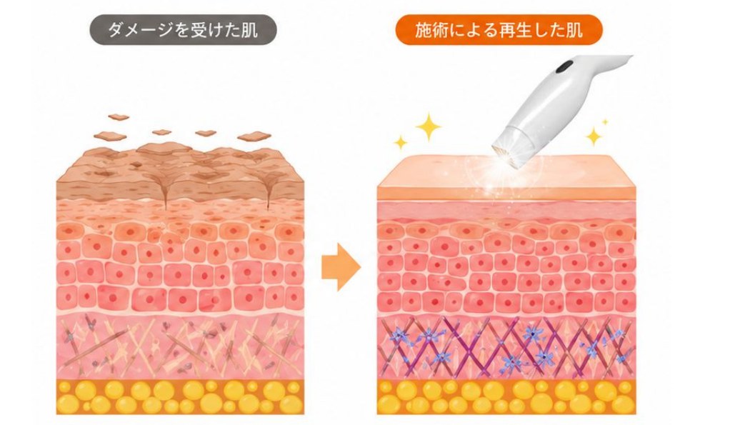 サーマル高周波の施術イメージ